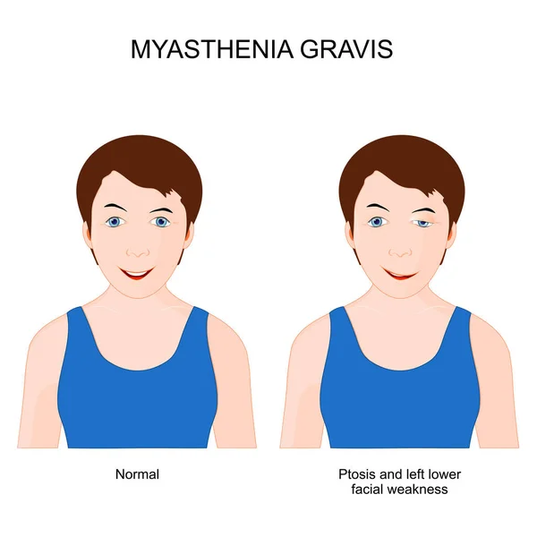 Myasthenia Gravis Girl Neuromuscular Disease Patient Ptosis Left Lower Facial — Stockový vektor