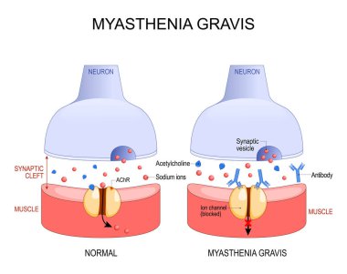Myasthenia gravis. Autoimmune disease. space between neuron and muscle. In myasthenia gravis, abnormal antibodies prevent acetylcholine from binding, blocked ion channels and the normal communication process between muscles and nerves. Vector poster.