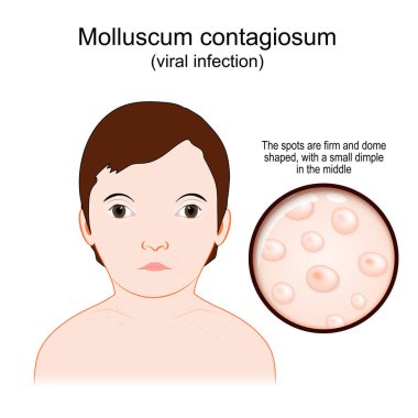 Molluscum contagiosum. Water warts is a viral infection that caused The spots on the Skin condition. Vector poster.