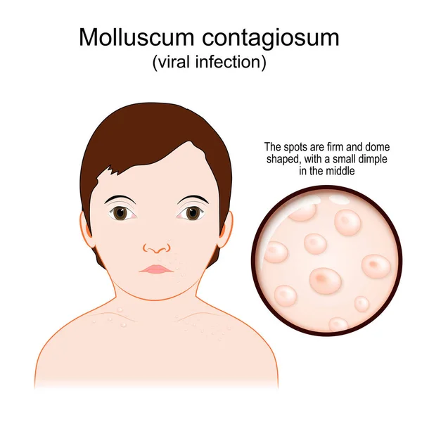 Molluscum Contagiosum Water Warts Viral Infection Caused Spots Skin Condition — Vetor de Stock