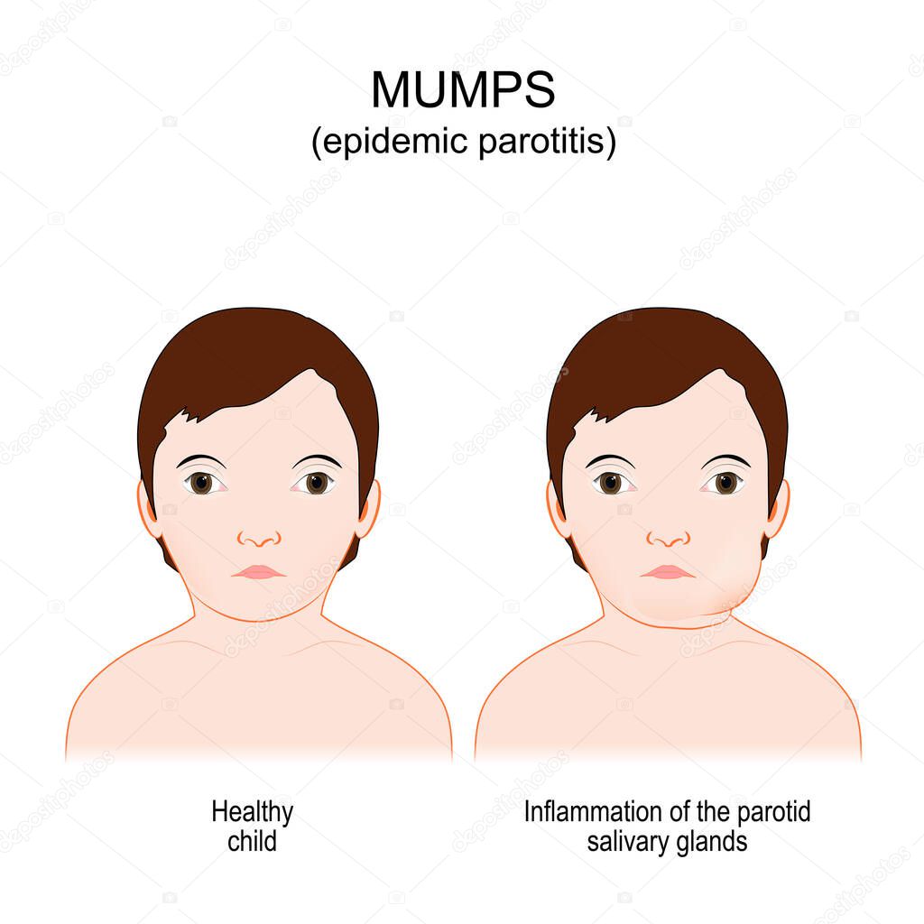 Mumps. Epidemic parotitis. viral disease caused by the mumps virus. Comparison and difference between Healthy child and boy with Inflammation of the parotid salivary glands. vector illustration