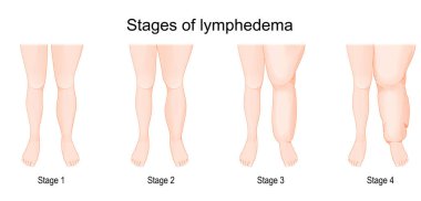 Severity of lower extremity lymphedema in different stages. Vector illustration 