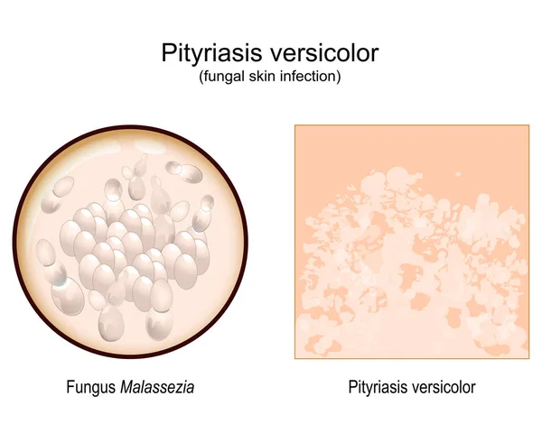 Pityriasis Versicolor Skin Surface Signs Symptoms Tinea Versicolor Close Malassezia — Stockvector