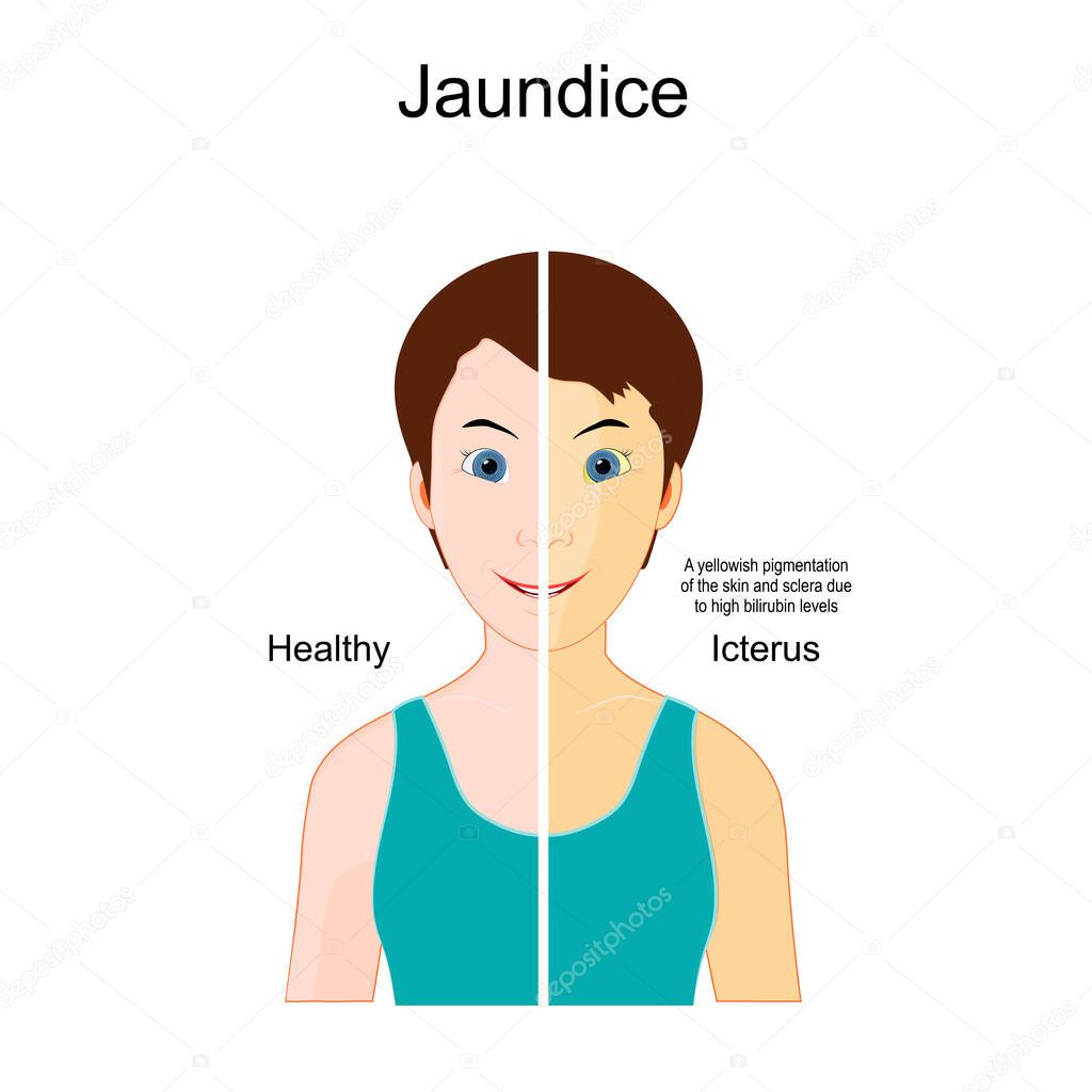 Jaundice. The Comparison between Healthy person and person with Icterus. yellowish pigmentation of the skin and sclera due to high bilirubin levels. health problems. vector illustration