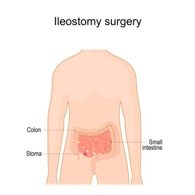 Ileostomy. stoma. surgical opening of small intestine, the ileum out the surface of the skin. surgical procedure. Vector illustration 