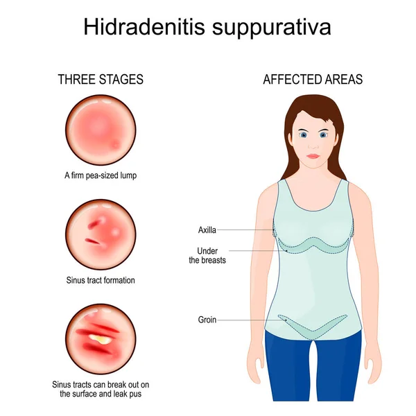 Hidradenitis Suppurativa Επηρεασμένες Περιοχές Ακμής Αντιστρόφως Τρία Στάδια Της Νόσου — Διανυσματικό Αρχείο