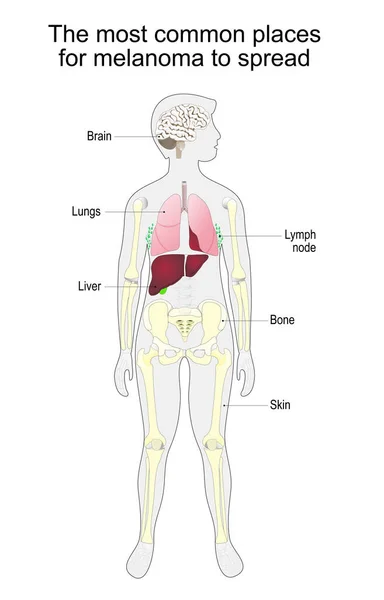 Metastasis Skin Cancer Malignant Melanoma Most Common Places Melanoma Spread — Archivo Imágenes Vectoriales