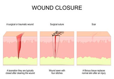 Wound closure. From surgical or traumatic wound to suture and scar. A laceration they are typically closed after cleaning the wound. Wound sewn with four stitches. A fibrous tissue replaces normal skin after an injury  healing process. vector diagram