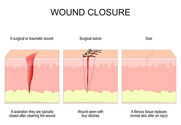 Wound Closure Surgical Traumatic Wound Suture Scar Laceration Typically Closed — Vetor de Stock
