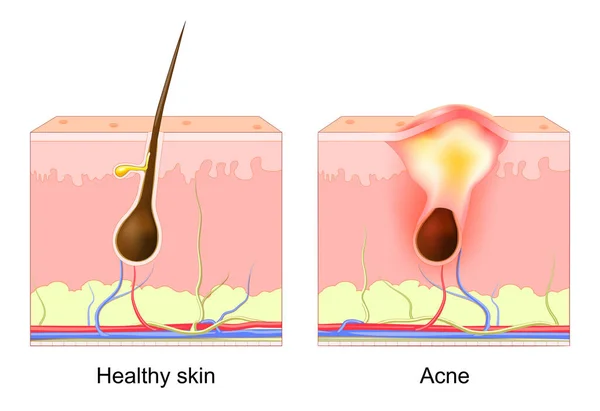 Acne Pimple Normal Hair Follicle Clogged Pore Difference Healthy Skin — ストックベクタ