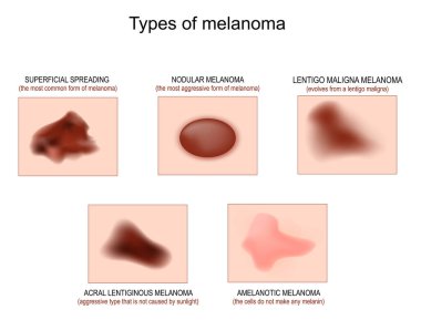 Types of skin cancer. Superficial spreading melanoma, Lentigo maligna and Nodular melanoma, Amelanotic cancer, and Acral lentiginous melanoma. Vector illustration. check nevus. Poster for Oncology, dermatology and medical use.