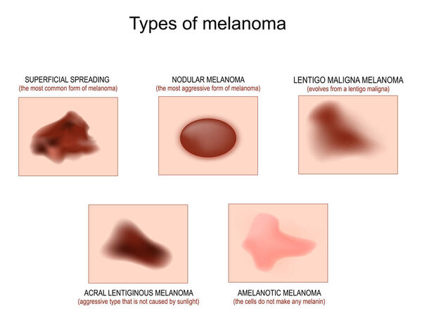 Types of skin cancer. Superficial spreading melanoma, Lentigo maligna and Nodular melanoma, Amelanotic cancer, and Acral lentiginous melanoma. Vector illustration. check nevus. Poster for Oncology, dermatology and medical use.