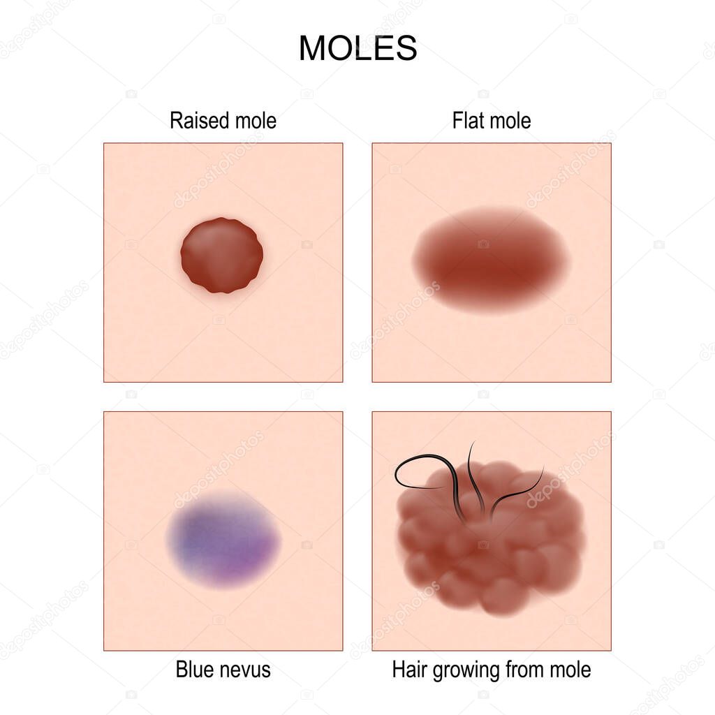 Nevus or mole types. check nevus. Blue nevus, Flat or Raised mole. Hair growing from mole. Poster for Oncology, dermatology and medical use. Vector illustration. 