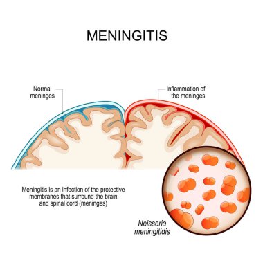 Meningitis is an infection of the protective membranes that surround the brain and spinal cord. Human's brain with Normal meninges and Inflammation of the meninges. Close-up of Neisseria meningitidis is a Gram-negative bacterium