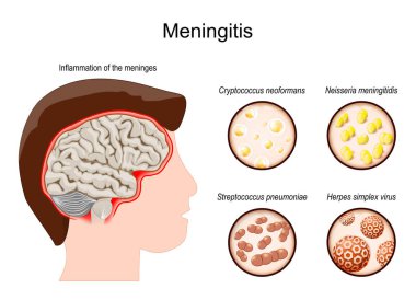 Meningitis. Human's brain with Inflammation of the meninges. Pathogens that caused this disease. The inflammation may be caused by infection with viruses like Herpes, bacteria Neisseria or Streptococcus, fungi like Cryptococcus or other microorganism