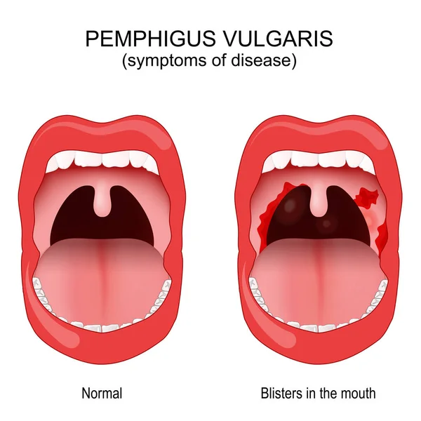 Pemphigus Vulgaris Problem Immune System Person Wit Affected Area Mouth — Stock Vector