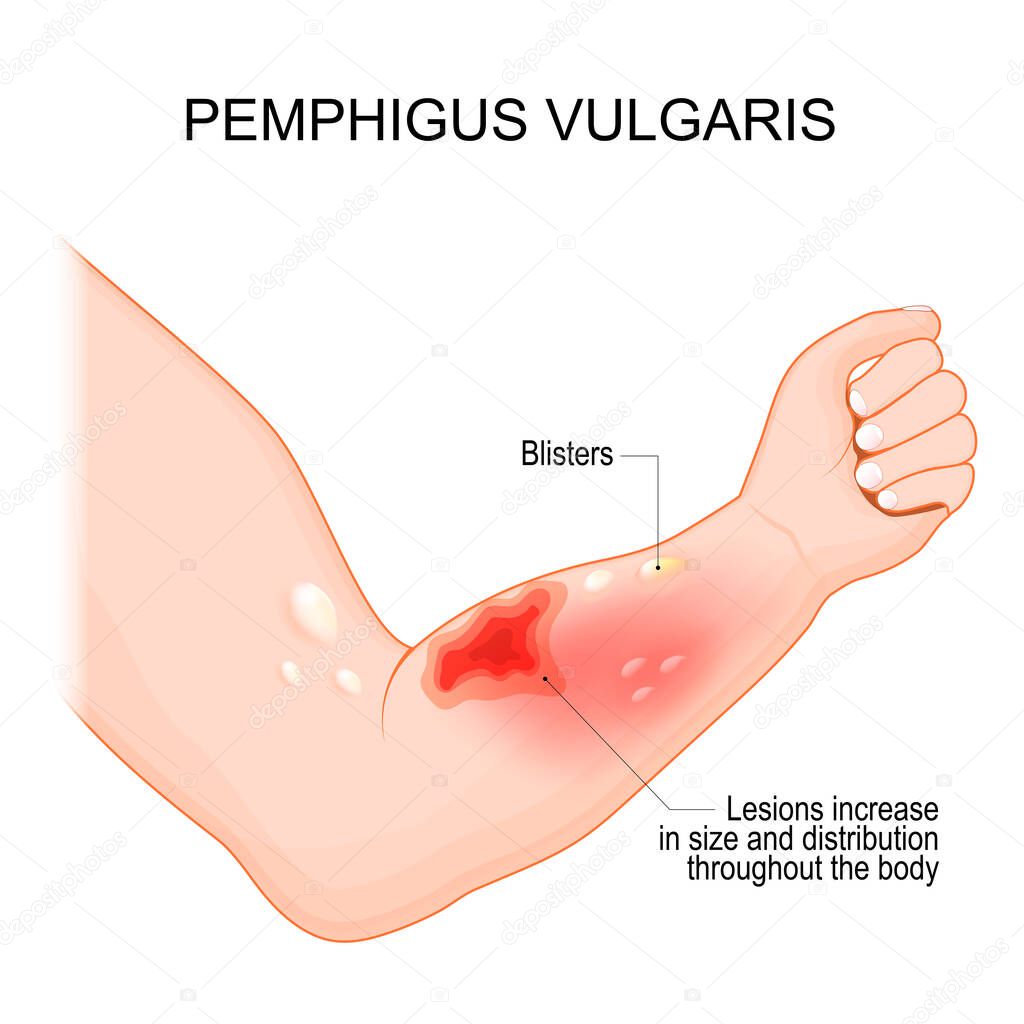 Pemphigus vulgaris. Arm with Blisters and Lesions that increase in size and distribution throughout the body. Symptoms of autoimmune disease. Skin condition. vector illustration