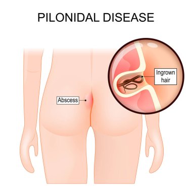 Pilonidal disease. skin infection. Close-up of a cyst with Ingrown hair between the cheeks of the buttocks. Pilonidal cyst, abscess, or fistula. pilonidal sinus, sacrococcygeal cyst. Vector illustration 
