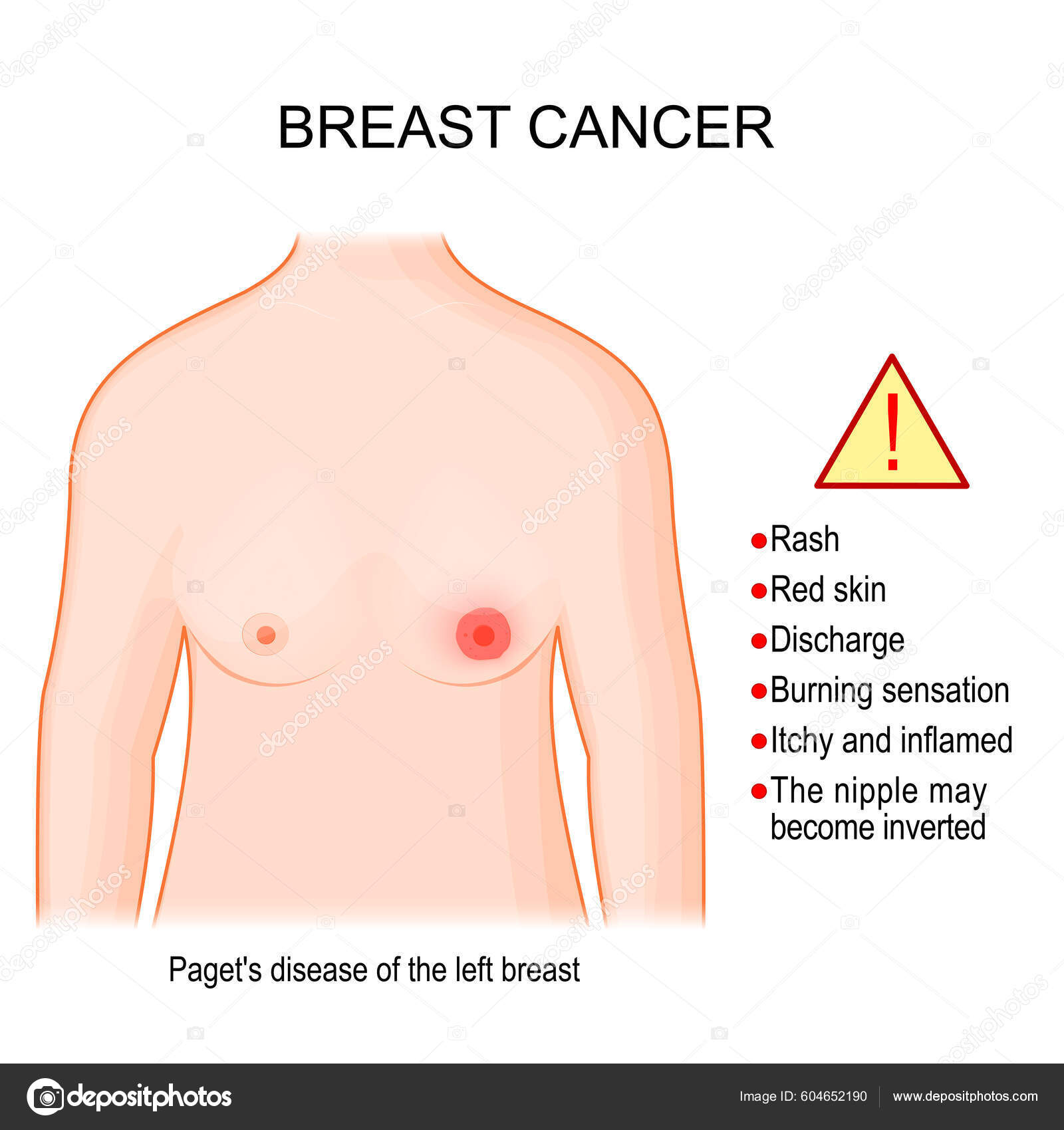 Paget's disease of the breast