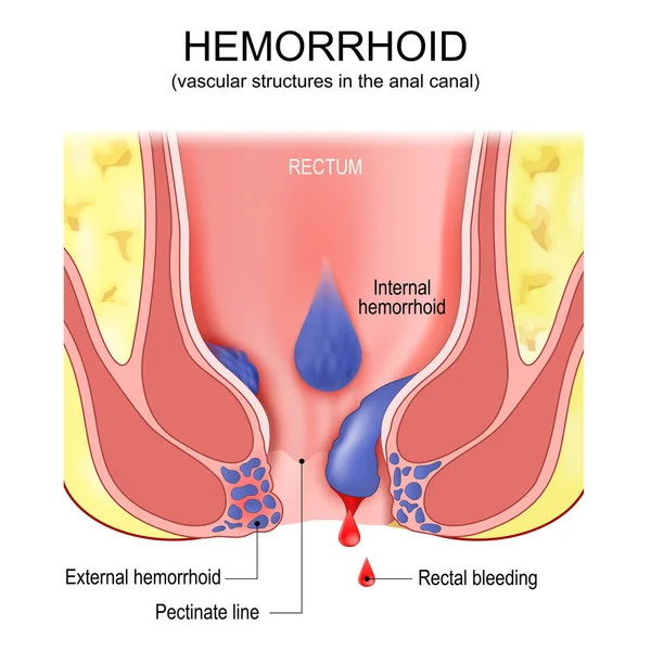 Piles Hemorrhoidal Disease Anatomy Internal External Hemorrhoids Cross Section Rectum — Stok Vektör