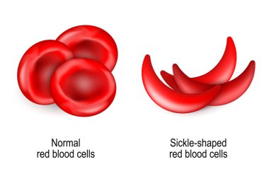 Sickle cell disease. SCD is a blood disorder inherited from a person's parents. sickle cell anaemia. Comparison and difference between normal erythrocytes and sickle-shaped red blood cells. Vector illustration