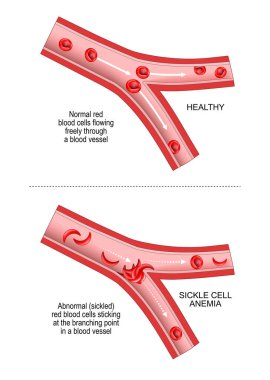 Sickle cell disease. SCD is a disorder inherited from a person's parents. anaemia, or anemia. Comparison and difference between blood vessel and erythrocytes of healthy person and abnormal red blood cells sticking at the branching point In a blood ve