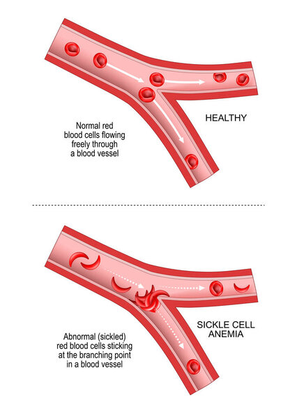 Sickle cell disease. SCD is a disorder inherited from a person's parents. anaemia, or anemia. Comparison and difference between blood vessel and erythrocytes of healthy person and abnormal red blood cells sticking at the branching point In a blood ve