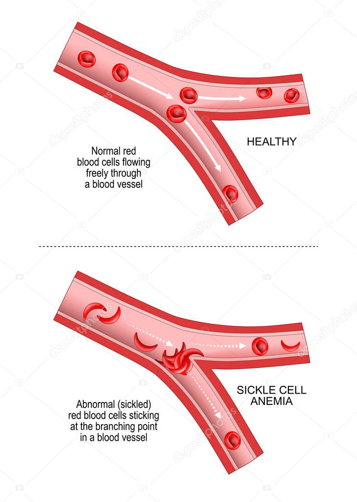 Sickle cell disease. SCD is a disorder inherited from a person's parents. anaemia, or anemia. Comparison and difference between blood vessel and erythrocytes of healthy person and abnormal red blood cells sticking at the branching point In a blood ve