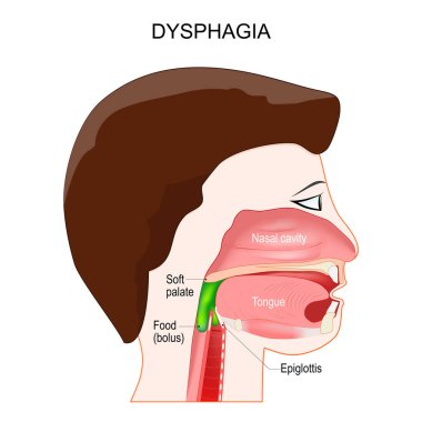 Dysphagia. aspiration food or liquid into the lungs. Swallowing and Process of deglutition. The Epiglottis not closes to prevent aspiration. Vector poster for education