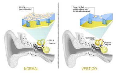 Benign paroxysmal positional vertigo. BPPV is a disorder arising from a problem in the inner ear. labyrinth of the inner ear with Semicircular canals. Comparison and difference between Normal vestibular system and Vertigo when Small calcified otolith clipart