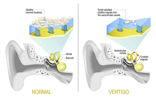 Vertiges Paroxystiques Bénins Positionnels Vppb Est Trouble Découlant Problème Dans — Image vectorielle