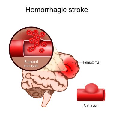 Hemorajik felç. Hematomalı insan beyni. Doku hasarı genişleyen bir hematomdan dolayı doku sıkışmasına neden olmuş. Anevrizması patlamış ve intraserebral kanaması olan kan damarına yakın çekim. Beyin atardamarında intrakraniyal anevrizma. vektör konumları