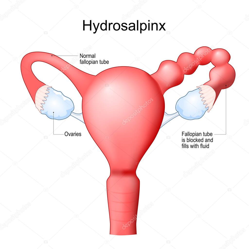 Human uterus with blocked of Fallopian tube. Hydrosalpinx cause infertility. Female reproductive system. Frontal view. Human anatomy. Realistic medical illustration. Vector poster