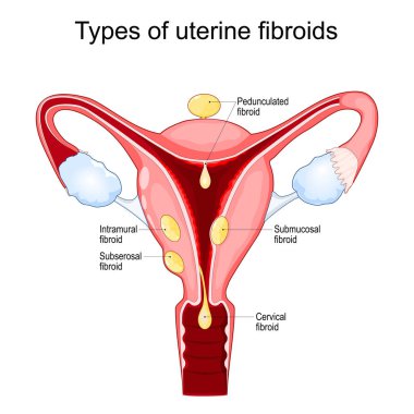 Rahim fibroidi. Subserosal, intramural, submukozal ve pedunküle fibroid. İyi huylu tümörler. Miyoma. Dişi üreme sistemi. Vektör illüstrasyonu