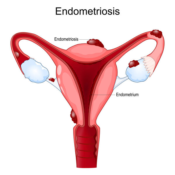 Endometriosis. Female reproductive system. Human uterus with cells endometrium that grow outside the uterus. female diseases. vector poster