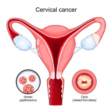 Rahim ağzı kanseri. Karsinom. Rahimdeki hücrelerden kaynaklanan habis neoplazma. Hastalığa neden olan insan papillomavirüs enfeksiyonuna (HPV) yakın çekim. Rahmin kesme görüntüsü. Aşağıdan rahim boynu görünüyor. Kadın üreme sistemi. Vektör