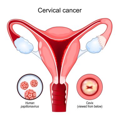 Cervical cancer. Carcinoma. Malignant neoplasm arising from cells in the cervix uteri. Close-up of the Human papillomavirus infection (HPV) that causes disease. cut-away view of the uterus. cervix viewed from below. female reproductive system. Vector clipart