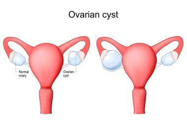 Yumurtalık kisti. Yumurtalığın içinde sıvı dolu bir kese olan insan rahmi. Dişi üreme sistemi. Vektör illüstrasyonu