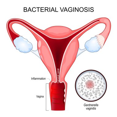 Bacterial vaginosis. disease of the vagina caused by excessive growth of bacteria of Gardnerella. Cross section of Human uterus. Close-up of G. vaginalis. Female reproductive system. sexually transmitted infections. Vector illustration clipart