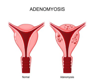 Adenomyosis. Comparison and difference between normal and unhealthy abnormal uterus. female reproductive system. medical condition when cells endometrium atypically located among the cells of the uterine myometrium. This tissue sheds and bleeds durin clipart
