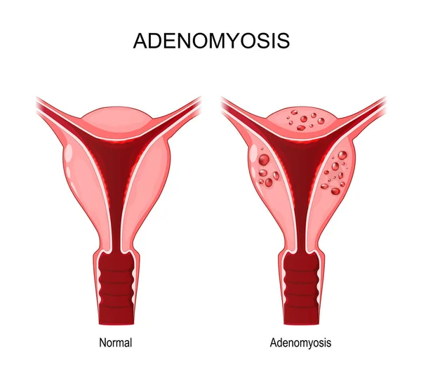 Adenomyose Vergelijking Verschil Tussen Normale Ongezonde Abnormale Baarmoeder Vrouwelijk Voortplantingssysteem — Stockvector