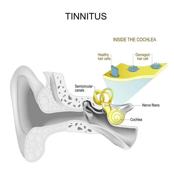 Tinnitus Oído Humano Parte Del Sistema Auditivo Dentro Cóclea Primer — Vector de stock