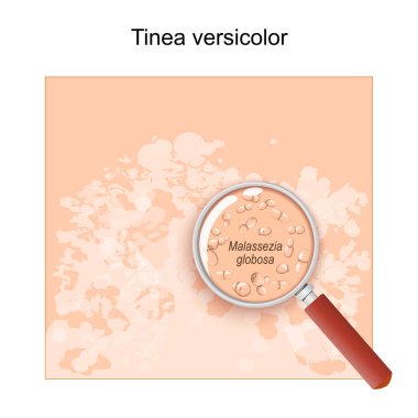 Tinea versicolor. Pityriasis versicolor semptomları olan insan derisi. Tinea flava ya da lota gibi deri hastalıklarına neden olan Malassezia globosa mantarına yakın çekim. Büyüteç altında maya. Vektör illüstrasyonu