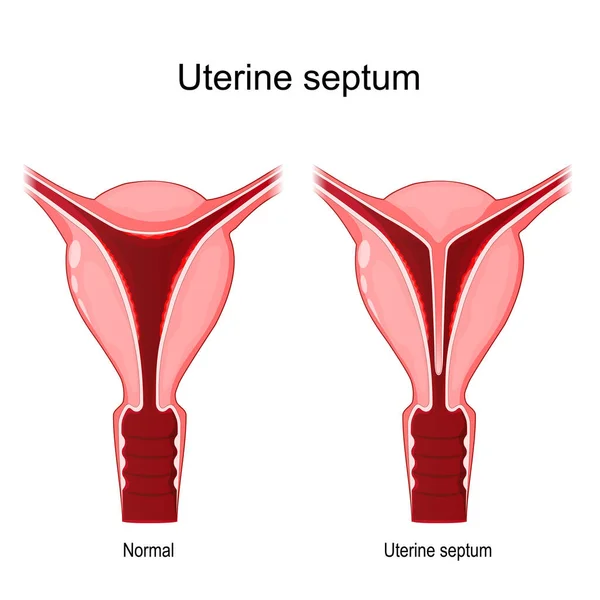 Uterine Septum 입니다 비정상 자궁을 비교하는 차이점 일러스트 — 스톡 벡터