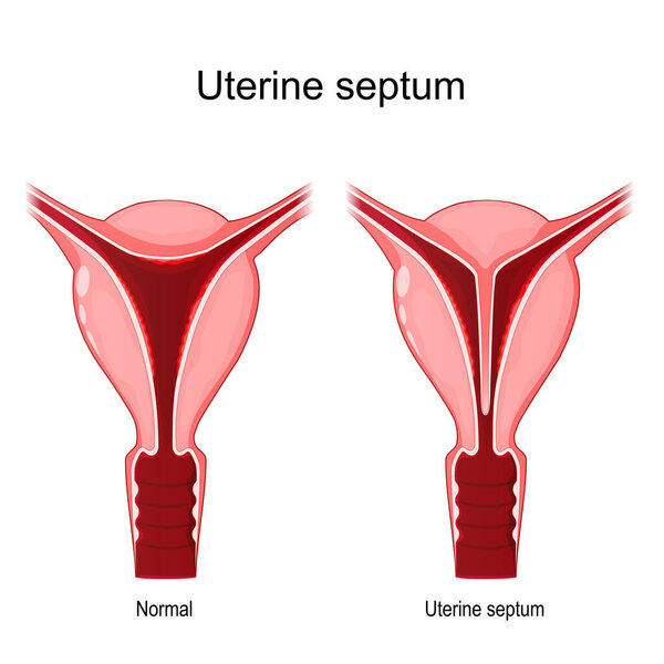 Uterine septum. Comparison and difference between normal and abnormal uterus. female reproductive system. uterine malformations. Vector illustration