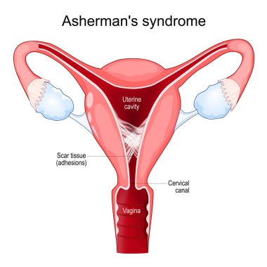 Asherman sendromu. Rahmin çapraz kesitinde adhezyonlar var. Rahim boşluğunda yara dokusu var. Rahim içi sinnechiae. Kısırlık sorunları. Dişi üreme sistemi. Vektör posteri
