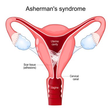 Asherman's syndrome. Cross section of uterine with adhesions. scar tissue in the uterine cavity. Intrauterine synechiae. Problems of infertility. Female reproductive system. Vector poster clipart