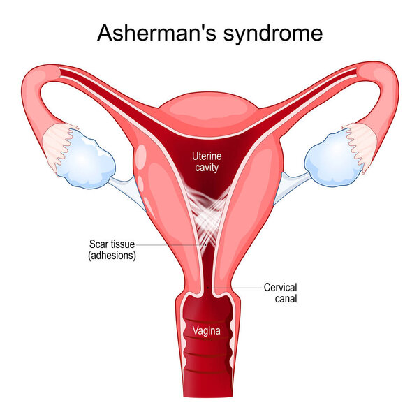 Asherman's syndrome. Cross section of uterine with adhesions. scar tissue in the uterine cavity. Intrauterine synechiae. Problems of infertility. Female reproductive system. Vector poster