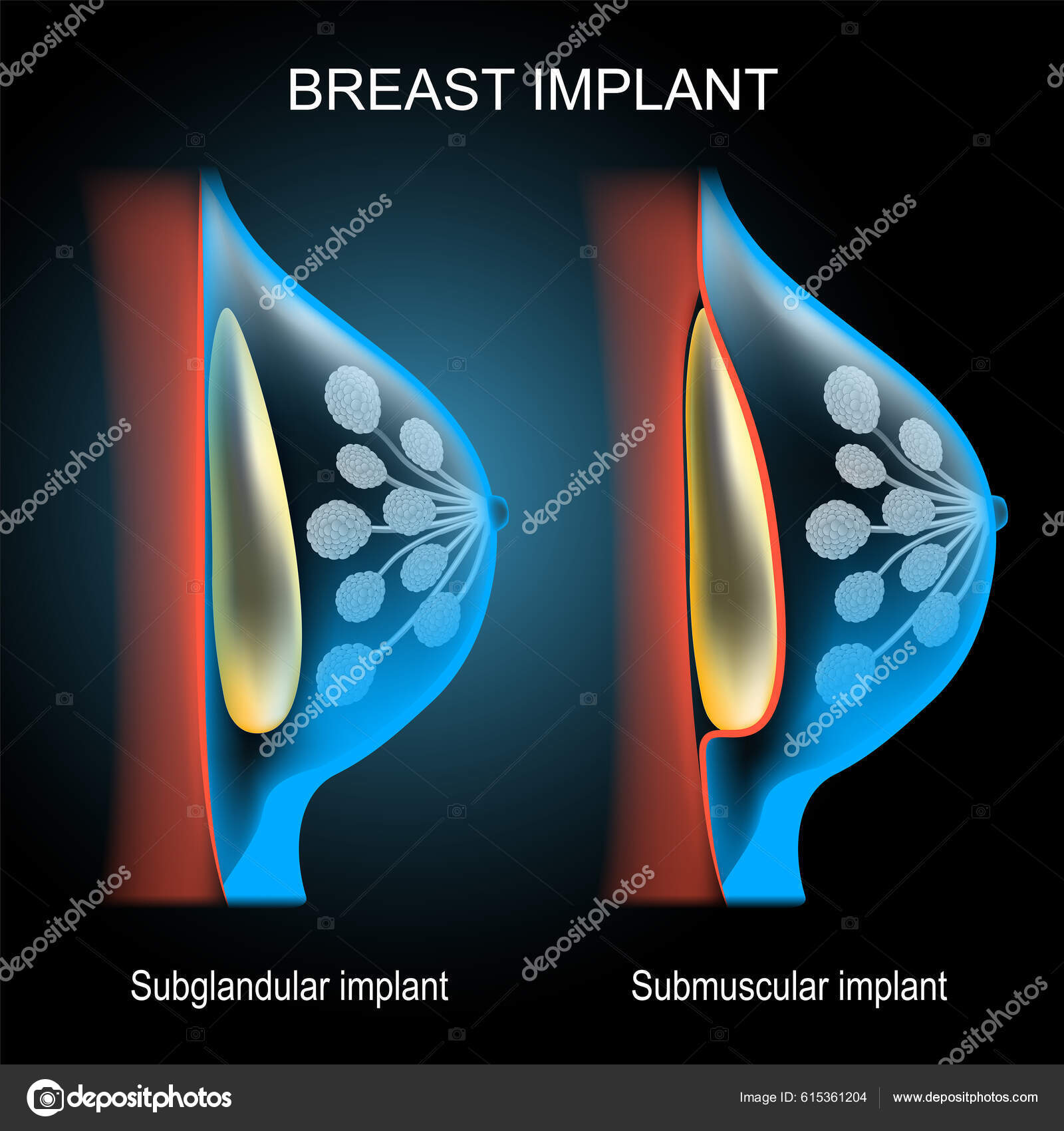 Breast fat transfer lift asymmetrical nipple sag rejuvenate