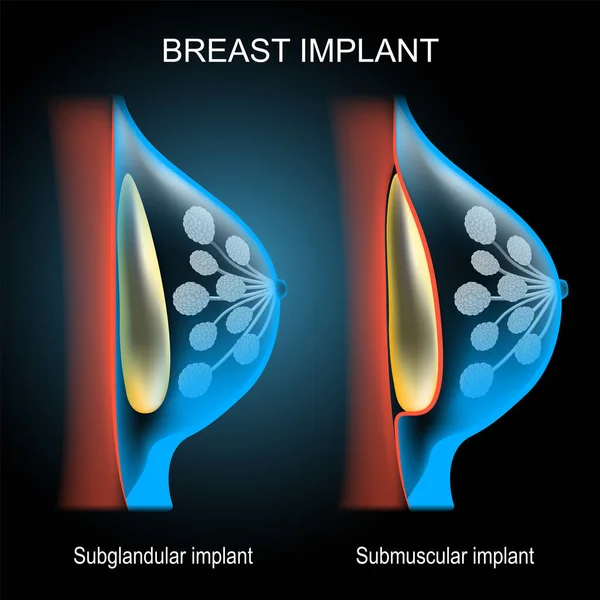 Mellimplantátum Elhelyezés Összehasonlítás Reális Poszter Emlőmirigy Implantátum Keresztmetszete Röntgenkék Szkennelés — Stock Vector